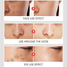 Load image into Gallery viewer, Dark Spot Remover For Face Sun Melasma Freckles Pigment Age Spots