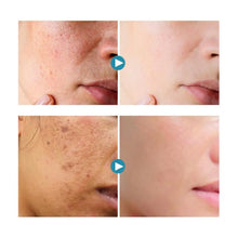 Load image into Gallery viewer, Hyaluronic acid cream to lighten acne marks skin care  firming skin
