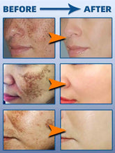 Load image into Gallery viewer, Dark Spot Remover cream for Face Removing Freckle Melasma