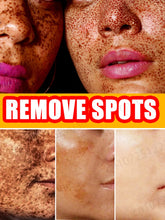 Load image into Gallery viewer, Freckle Removal Whitening Essence Liquid Decompose Melanin Fade Dark