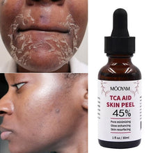 Load image into Gallery viewer, 45%Tca Aid Skin Peel Pore Minimizing Spots Remove Anti Wrinkle Skin