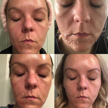 Load image into Gallery viewer, 45%Tca Aid Skin Peel Pore Minimizing Spots Remove Anti Wrinkle Skin