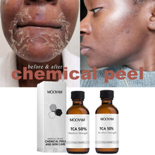 Load image into Gallery viewer, 50%TCA Chemical Peel Anti Aging Anti Wrinkle Peeling Serum for Repair