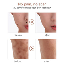 Load image into Gallery viewer, 9 levels Laser Plasma Pen Mole Removal Dark Spot Remover LCD Skin Care