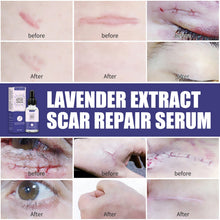 Load image into Gallery viewer, Acne Scar Removal Serum Stretch Marks Treatment Pimples Acne Spots