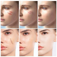 Load image into Gallery viewer, Acne Scar Removal Serum Stretch Marks Treatment Pimples Acne Spots