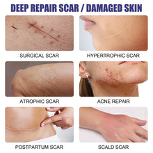 Load image into Gallery viewer, Acne Scar Removal Serum Stretch Marks Treatment Pimples Acne Spots