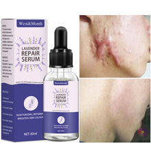 Load image into Gallery viewer, Acne Scar Removal Serum Stretch Marks Treatment Pimples Acne Spots